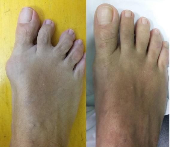 neuroma di morton chirurgia mininvasiva